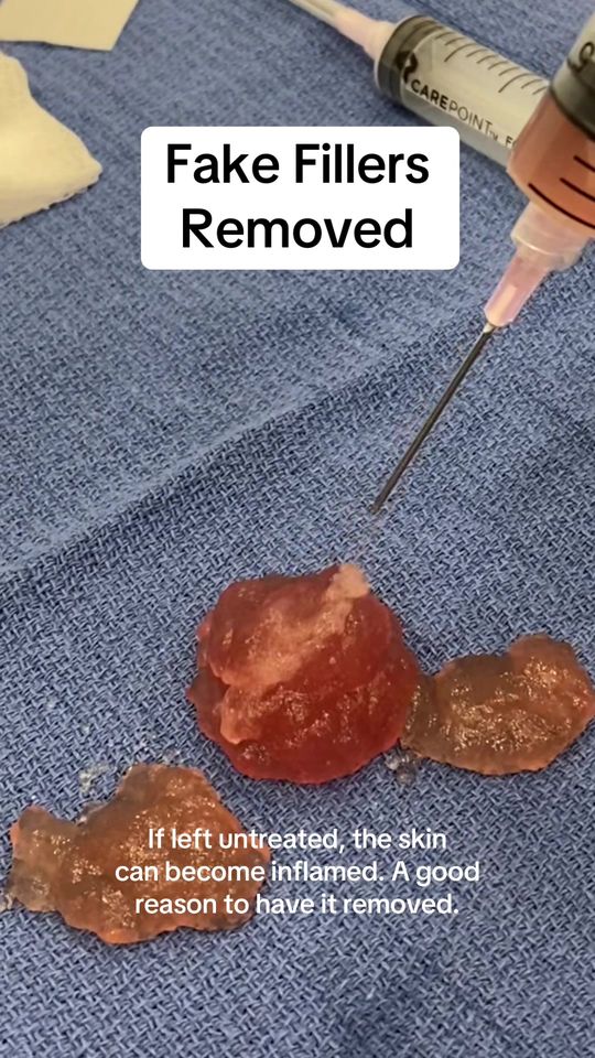 Video by Dr. Raffy Karamanoukian: Fake fillers removed from the skin.