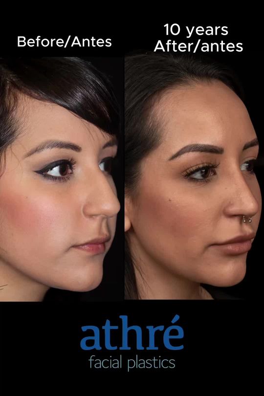 Video by Dr. Raghu Athre: Long term followup after a rhinoplasty. 10 years after a primary rhinoplasty.⠀Technique: Open str…