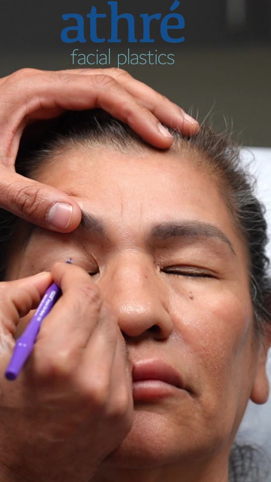 Video by Dr. Raghu Athre: Blepharoplasty is literally translated as changing the shape of the eyelid. It is the formal term…
