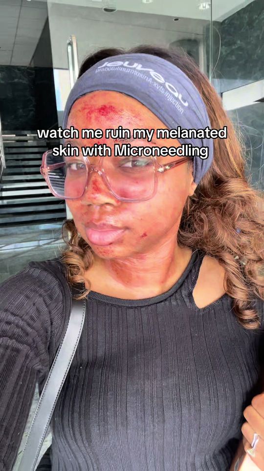 Video by Dr. Raheleh Sarbaziha: Trusting the process even when it doesn’t look pretty 😭✨ Microneedling + PRP on melanated skin =…
