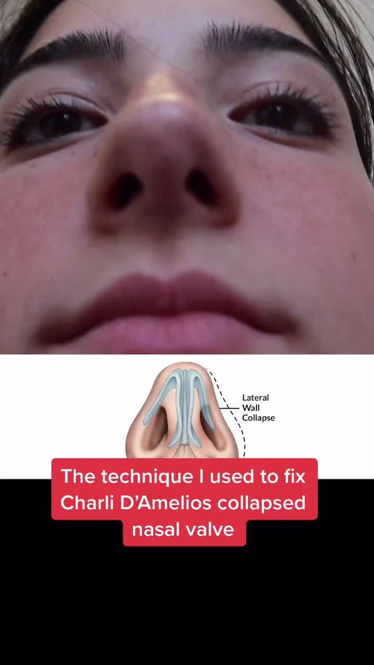 Video by Dr. Raj Kanodia: The technique I used to fix @charlidamelio collapsed nasal valve. This is a permanent repair usin…