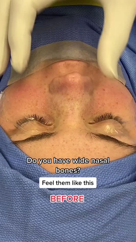 Video by Dr. Raj Kanodia: Narrowing of the nasal bones enhances the harmony in the eye-cheek complex