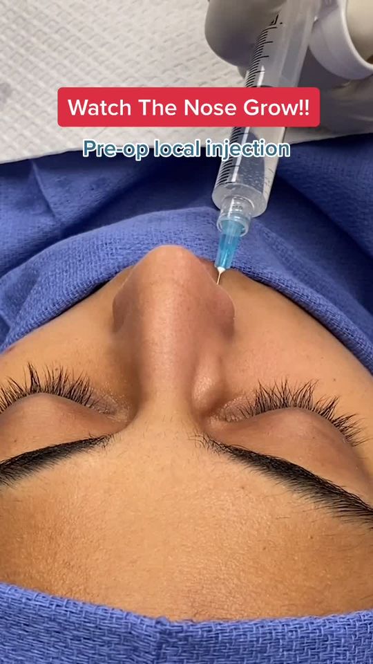 Video by Dr. Raj Kanodia: Can anyone guess what I am injecting? Crucial first step of surgery!