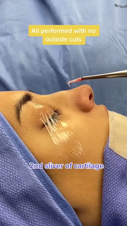 Video by Dr. Raj Kanodia: 100% of my surgical practice is focused on finesse, SCARLESS, closed rhinoplasty.
