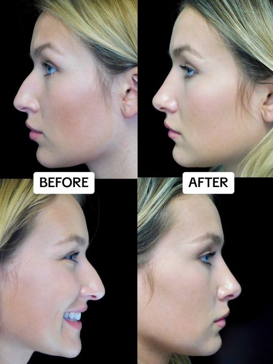 Video by Dr. Raj Kanodia: Always natural, always scarless 👃🏻