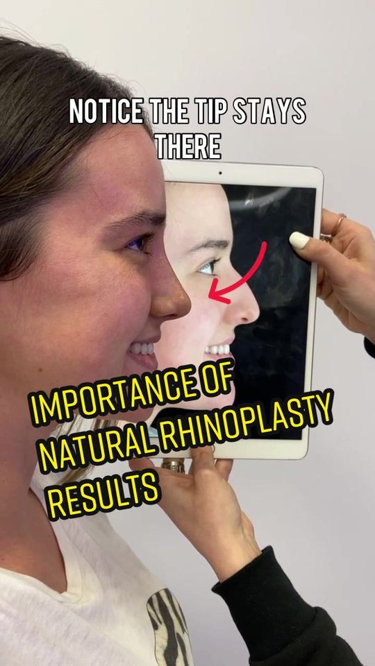 Video by Dr. Ramtin Kassir: Natural results are 🔑
