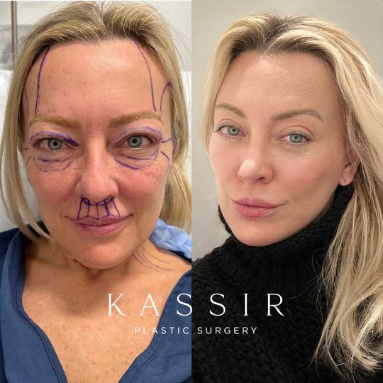 Video by Dr. Ramtin Kassir: Best facelift surgeon
