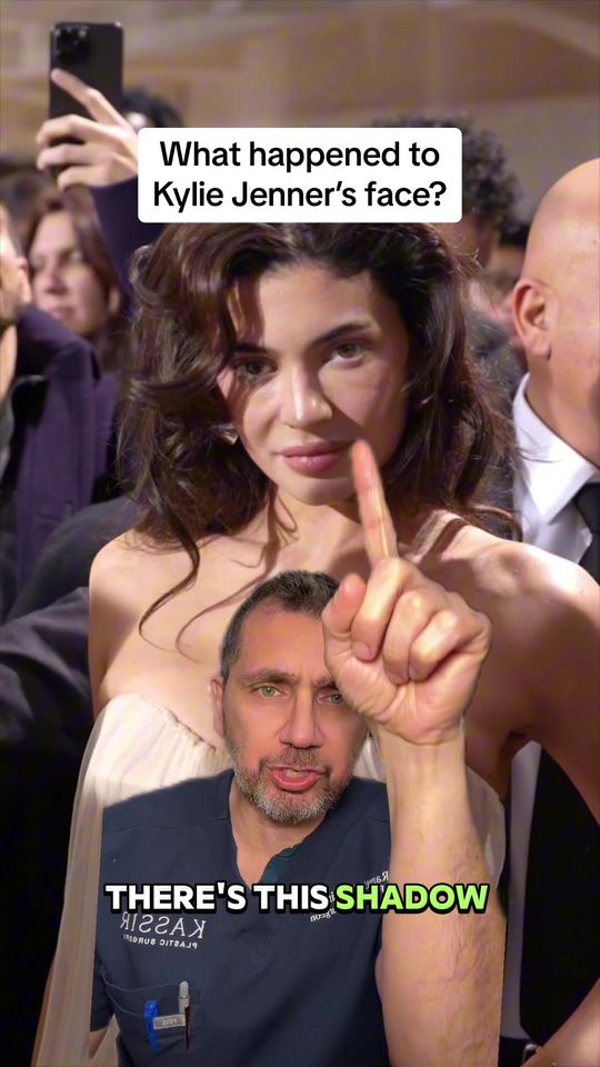 Video by Dr. Ramtin Kassir: What happened to Kylie Jenner’s face? 🤔 Facial Plastic Surgeon Reacts!