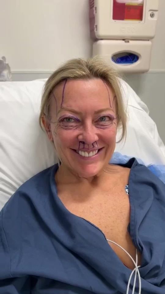 Video by Dr. Ramtin Kassir: Sharing our beautiful 51-year-old patient, 1 year post-op, following a comprehensive facial rejuv…