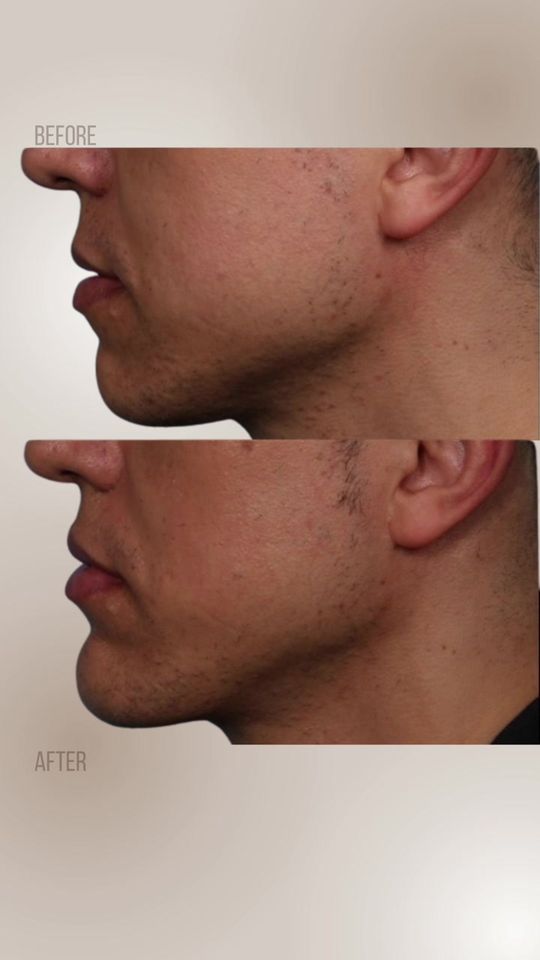 Video by Dr. Ran Y. Rubinstein: Our patient requested permanent facial balancing. Before surgery, his chin vertical height was to…