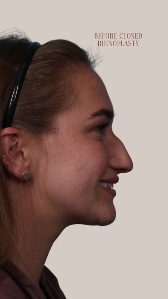Video by Dr. Ran Y. Rubinstein: Our patient is thrilled with her results 6 weeks after having a closed Rhinoplasty. The minimally…