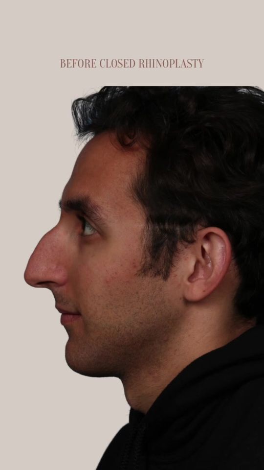 Video by Dr. Ran Y. Rubinstein: Our 24 year old patient was so ecstatic on his 3 month visit post endonasal (closed) rhinoplasty…