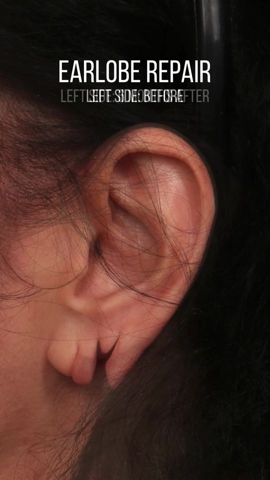 Video by Dr. Ran Y. Rubinstein: Torn earlobes repaired surgically! This patient was thrilled with her results just 6 months post…