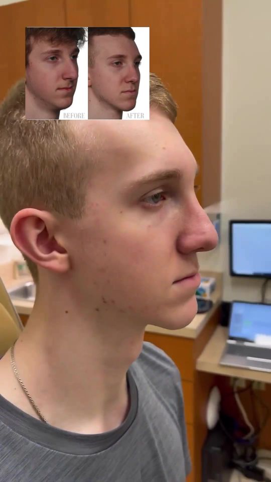 Video by Dr. Ran Y. Rubinstein: Our amazing patient is thrilled with his results 1 year after his Rhinoplasty with Septoplasty an…