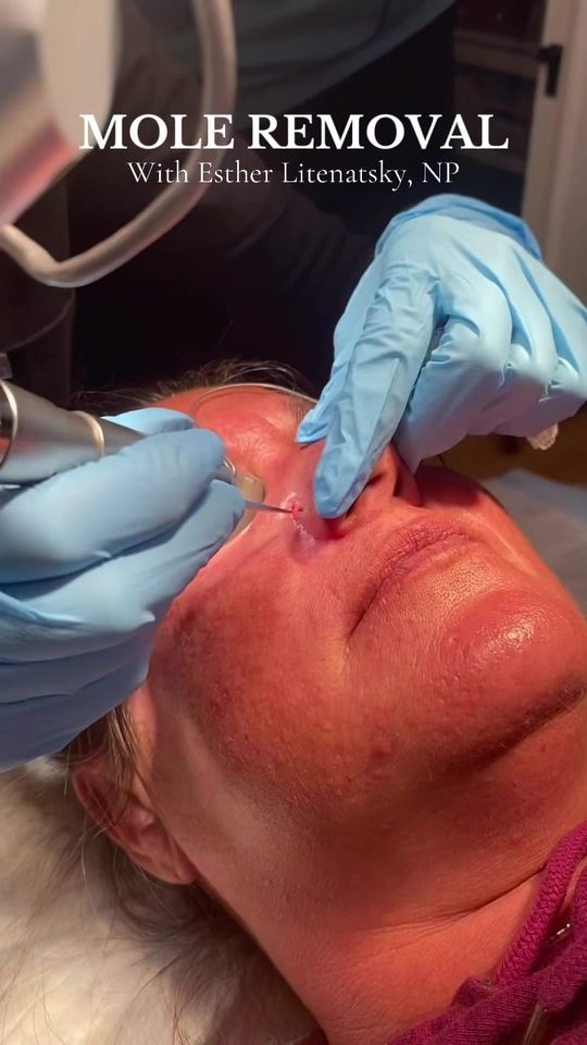 Video by Dr. Ran Y. Rubinstein: Mole removal using Fraxel Re:Pair laser 💥 A numbing agent is applied to the area prior to treatm…
