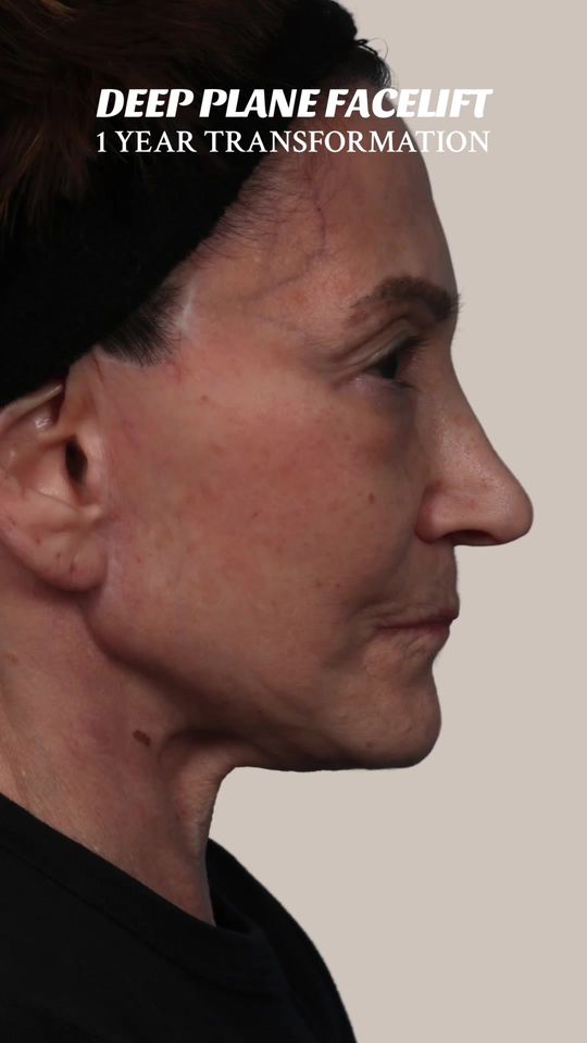 Video by Dr. Ran Y. Rubinstein: The deep plabe facelift provides a lifted, youthful appearance by raising the underlying facial t…