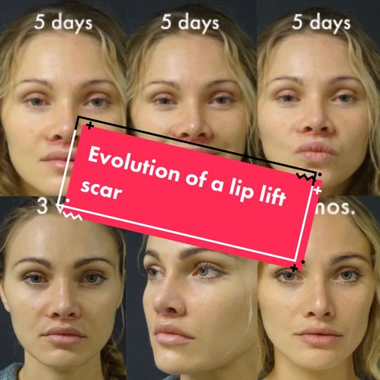 Video by Dr. Randal Haworth: Evolution of a lip lift scar 👄. 💎 www.DrHaworth.com