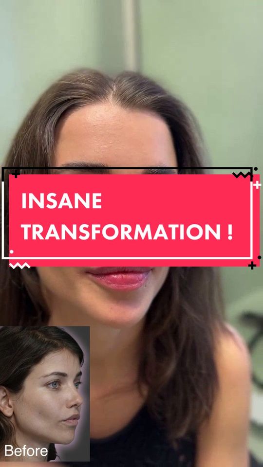 Video by Dr. Randal Haworth: This video has been taken 3 months after I performed a lip 👄 rescue and facial fat transfer. She…