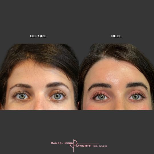 Video by Dr. Randal Haworth: REBL REBL-Rotational endoscopic brow lift-very powerful and permanent through 4 discrete incision…
