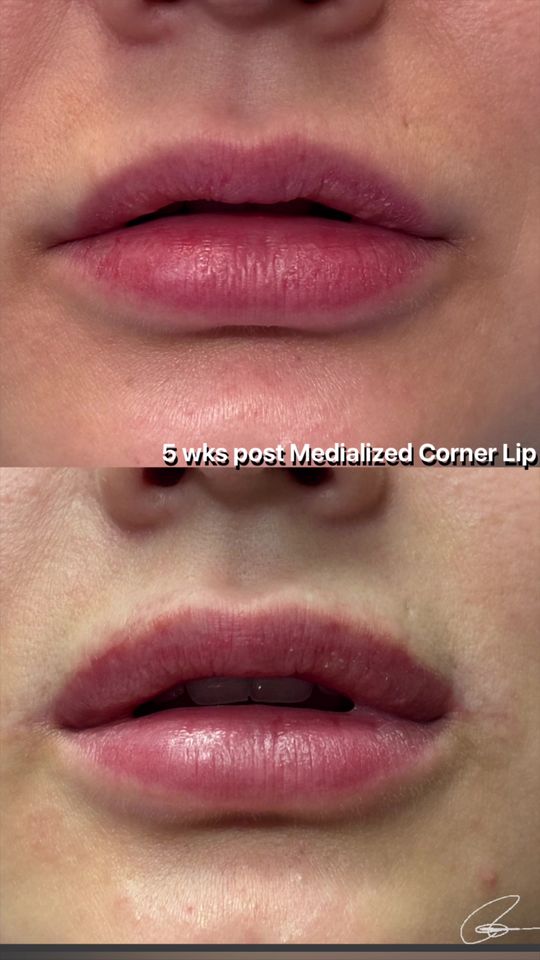 Video by Dr. Randal Haworth: The only way to correctly address an apostrophe lip deformity : The medialized corner lip lift 👄