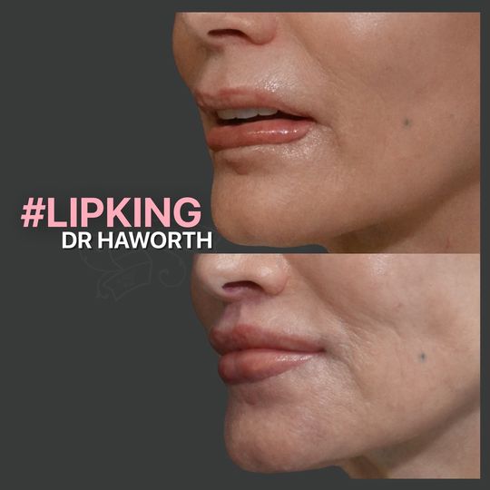 Video by Dr. Randal Haworth: 👄Lip rescue🛟 Lip reconstruction takes many forms. for example, this patient had suffered a surg…