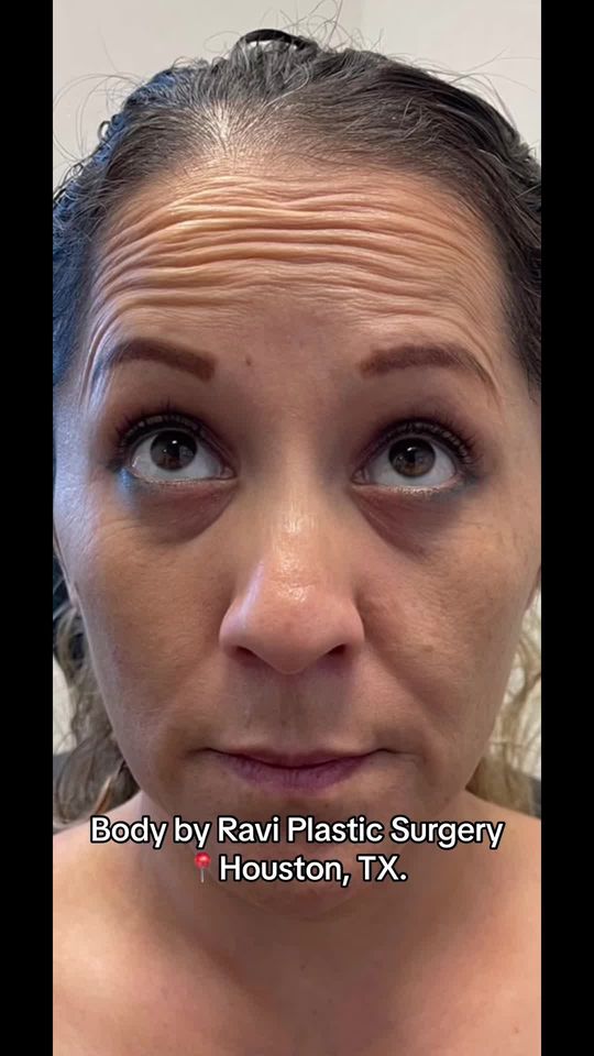 Video by Dr. Ravi Somayazula: Botox is the holy grail of anti aging!