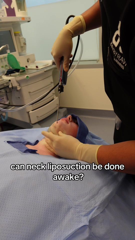 Video by Dr. Ravi Somayazula: Sculpting dreamy jawlines one patient at a time 🤩