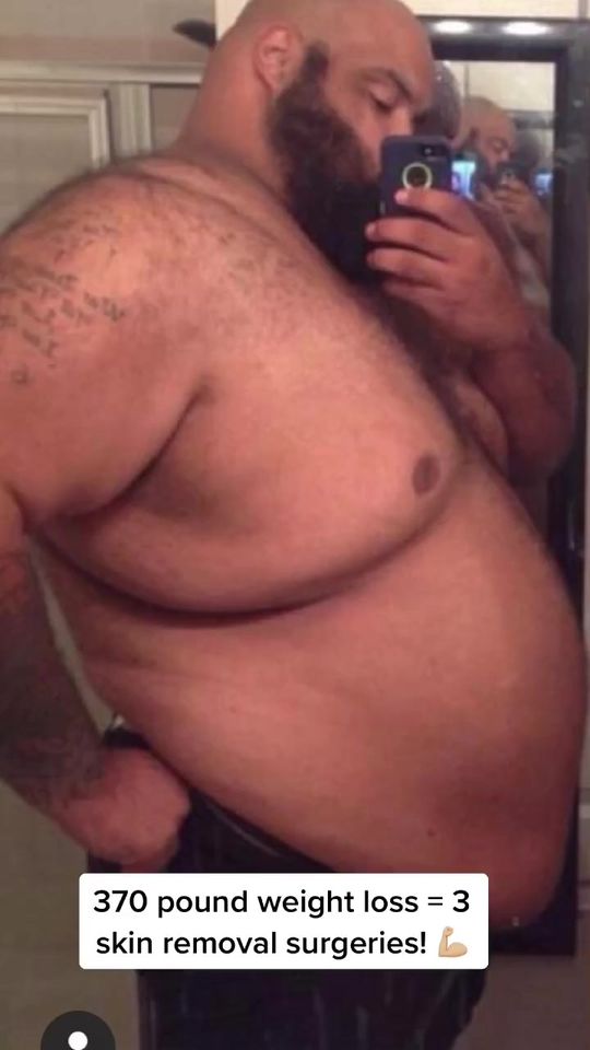Video by Dr. Remus Repta: 370 pound weight loss = 3 skin removal surgeries done by me!