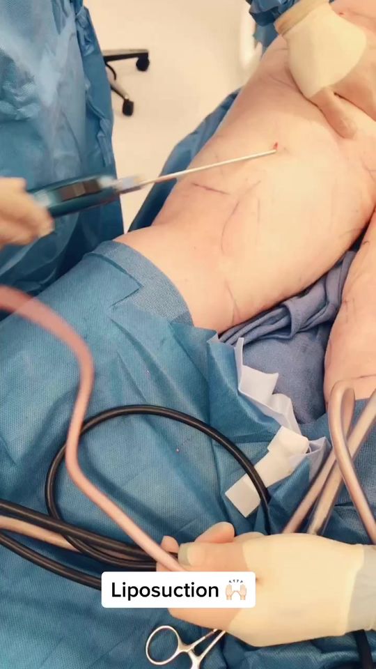 Video by Dr. Remus Repta: Liposuction is the only permanent fat reducer! 🙌🏻