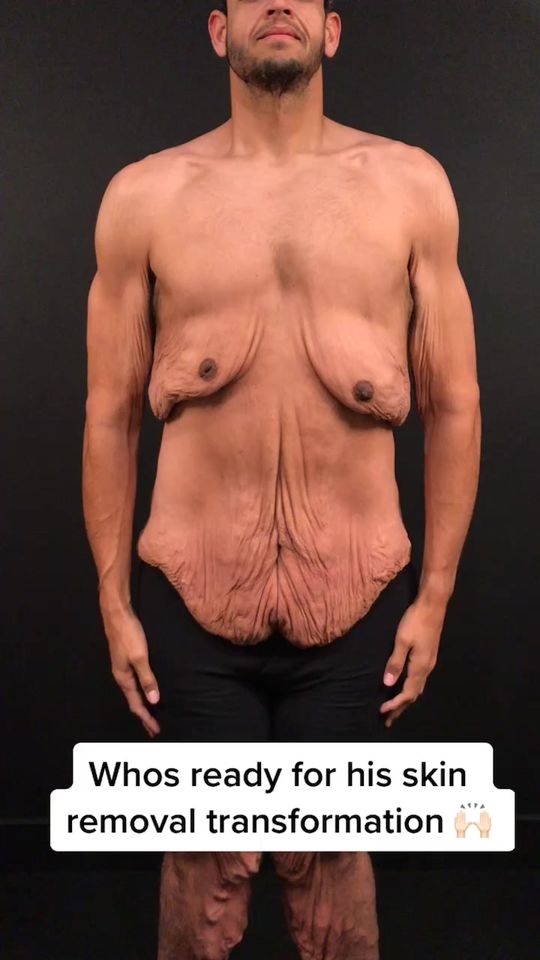 Video by Dr. Remus Repta: After a 475 pound weight loss, we are removing all his loose excess skin 🙌🏻