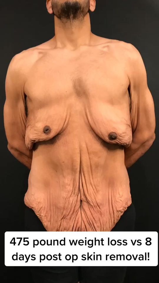 Video by Dr. Remus Repta: We removed 13 feet of skin 🤭