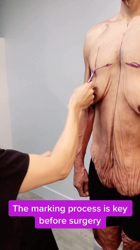 Video by Dr. Remus Repta: Marking the patient before surgery is key ⭐️