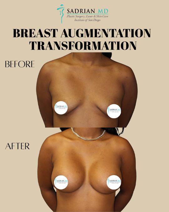 Video by Dr. Reza Sadrian: The goal of breast augmentation isn’t to look “done” — it’s to look balanced, proportional, and n…