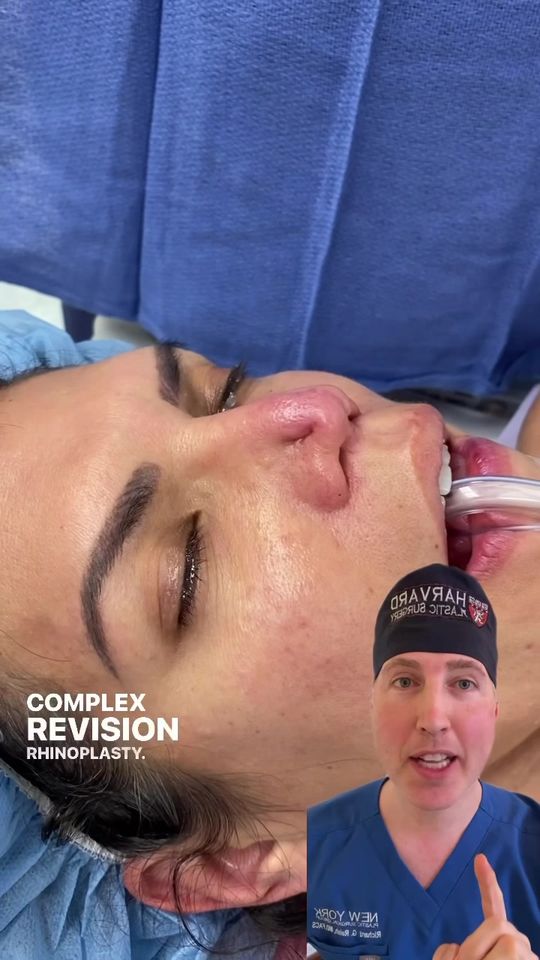 Video by Dr. Richard G. Reish: Complex revision rhinoplasty