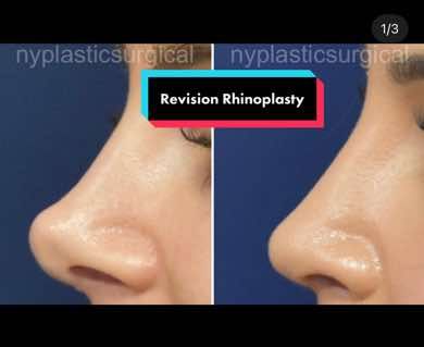 Video by Dr. Richard G. Reish: Revision Rhinoplasty