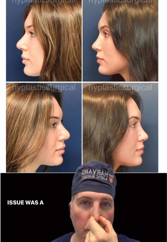 Video by Dr. Richard G. Reish: Primary rhinoplasty. Long term results matter most!