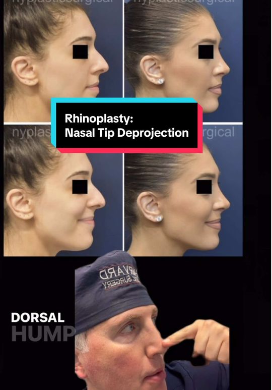 Video by Dr. Richard G. Reish: The power of nasal tip deprojection.