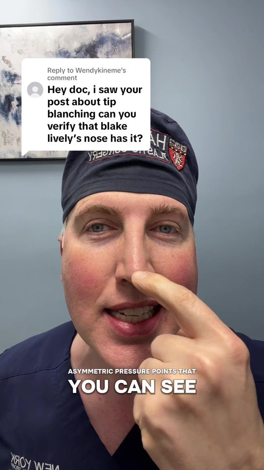Video by Dr. Richard G. Reish: Replying to @Wendykineme fixing the blanching pressure points in the nasal tip with revision rhin…