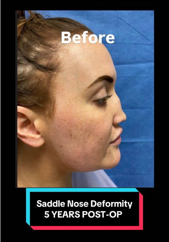Video by Dr. Richard G. Reish: Saddle nose deformity 5 YEARS post-op—because time reveals everything. Long-term results aren’t o…