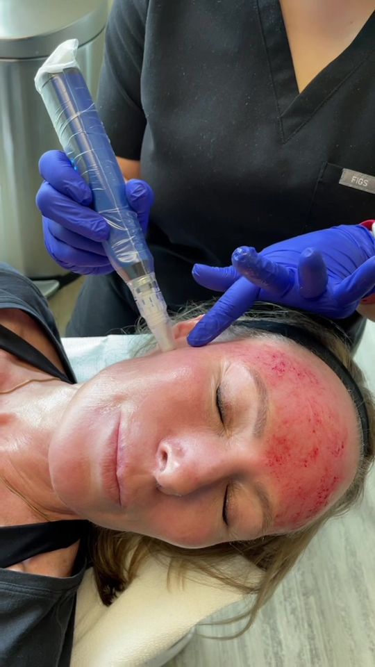 Video by Dr. Richard H. LeConey: Watch us perform our very popular SkinPen treatment (aka microneedling/vampire facial)