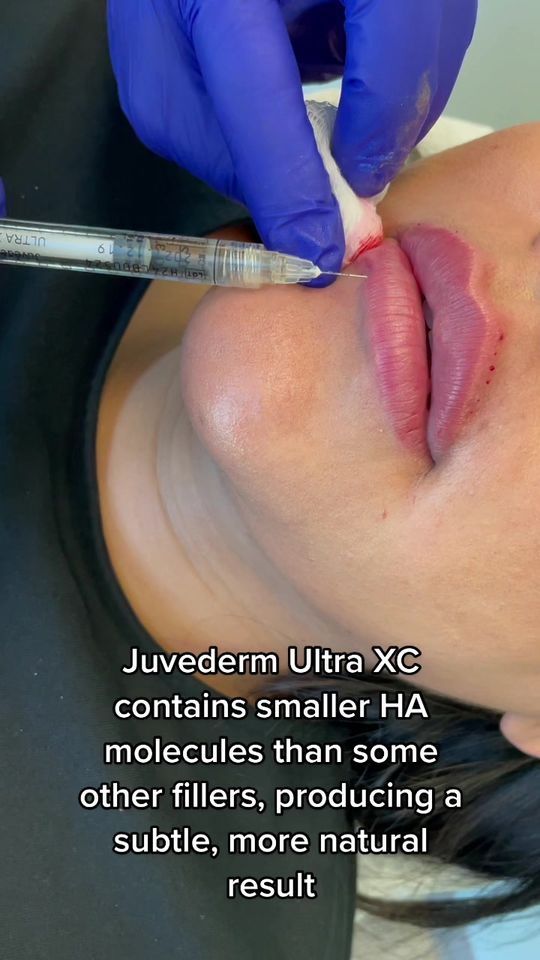 Video by Dr. Richard H. LeConey: One syringe of Juvederm Ultra can do wonders😍