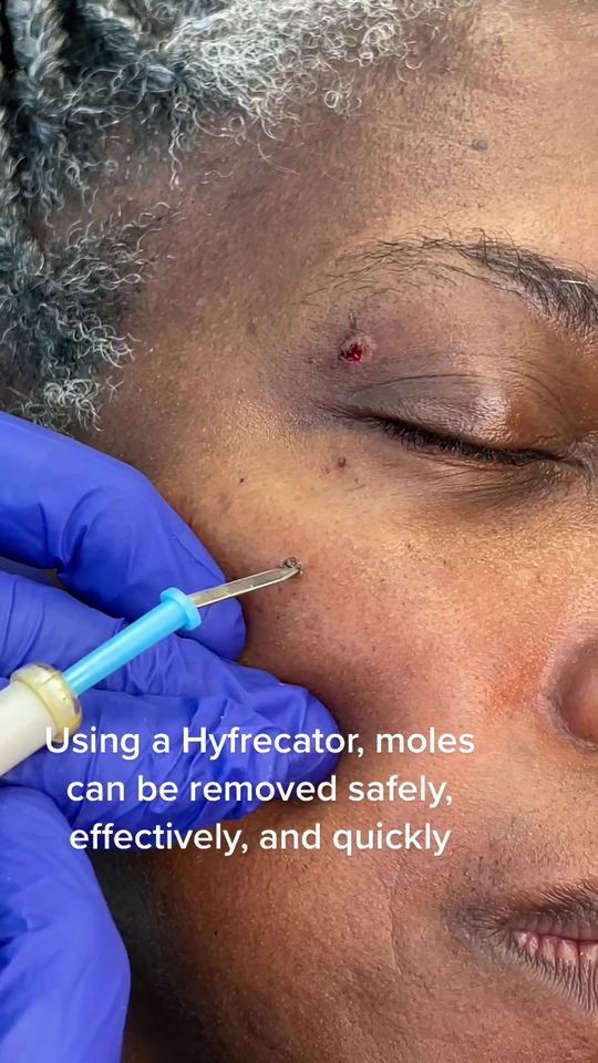 Video by Dr. Richard H. LeConey: Safe, effective, and quick mole removal using a ✨
