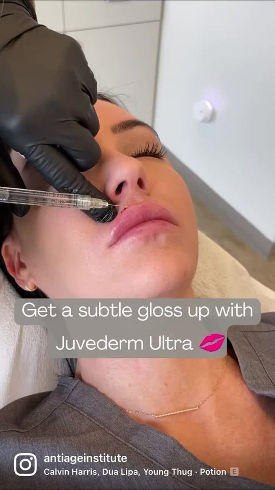 Video by Dr. Richard H. LeConey: Add volume and subtle definition with a syringe of Juvéderm Ultra 👄✨