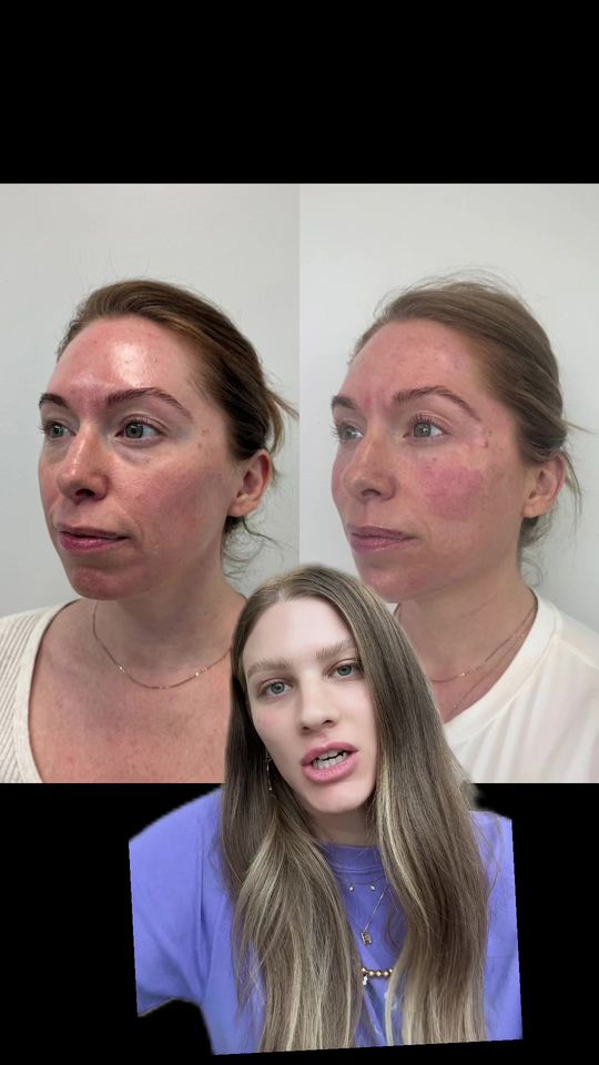 Video by Dr. Richard H. LeConey: Facial balancing > overfilling 👀✨ It’s not about adding more, it’s about placing it where it mat…