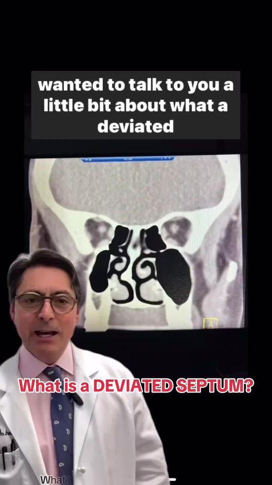 Video by Dr. Robert A. Guida: What is a DEVIATED SEPTUM? NYC ENT / Facial Plastic Surgeon Dr. Robert Guida talks about the nasa…