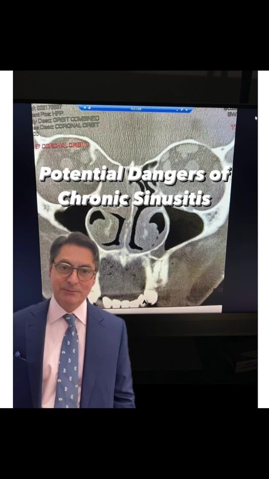 Video by Dr. Robert A. Guida: The Dangers of Chronic Sinusitis explained by NYC ENT/Facial Plastic Surgeon Dr. Robert Guida.