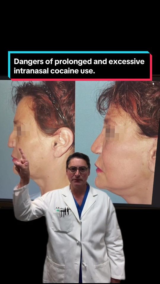 Video by Dr. Robert A. Guida: Cocaine use can destroy your nose! NYC nasal surgery specialist Dr. Robert Guida discusses the da…