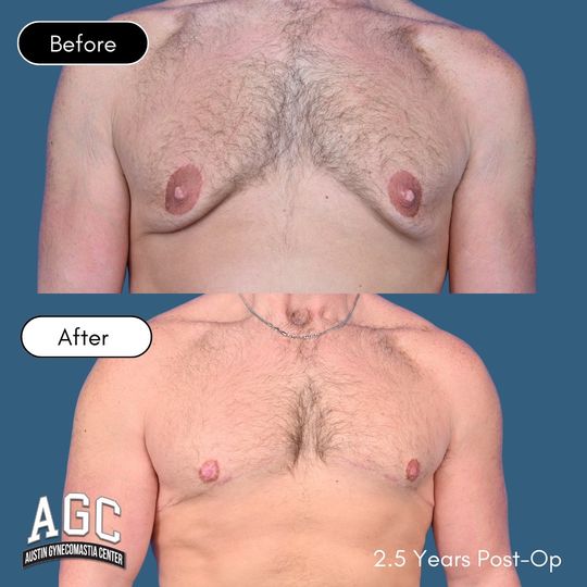 Video by Dr. Robert Caridi: For those of you asking about long-term results—here’s one 🙌 This amazing patient had gynecomast…