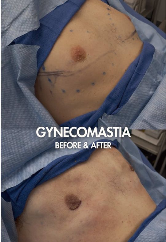 Video by Dr. Robert Caridi: This on-the-table result shows the immediate change after gynecomastia surgery, but healing is a…