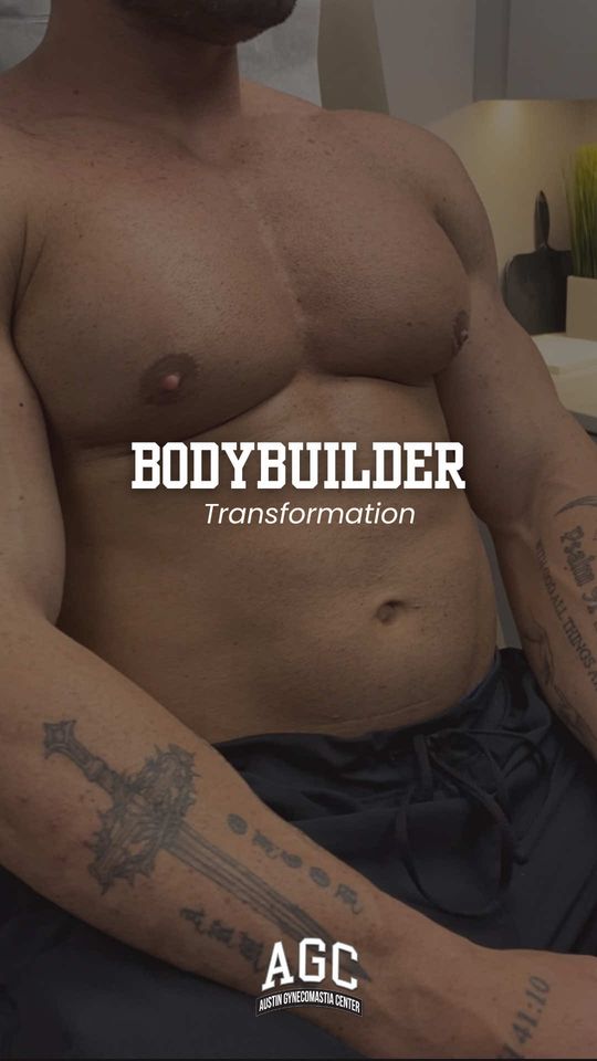 Video by Dr. Robert Caridi: A bodybuilder’s physique deserves a chest contour that matches the work. This patient is now 1 mo…